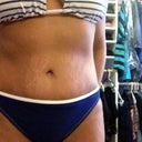 7 months PO. Front bikini view.