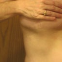9 months Scars under right breast