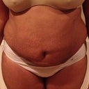 5 Weeks Post Op- Front