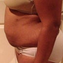5 week Post Op- Side Vew