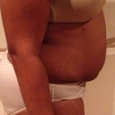 5 week Post Op- Side View