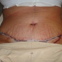 2 days Post OP