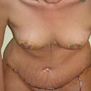 bending forward 4 days Post OP
