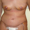 still crooked 7 days Post OP