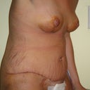 side view 7 days Post OP