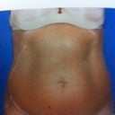 BEFORE - FRONT