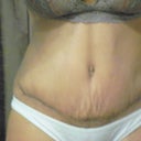 19 days post op, lots of swelling..especially towards the incision and hips