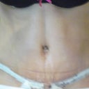 Two days post op