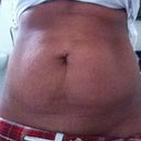 Pre-OP--although I am a tiny girl I was miserable with this sac of loose skin and stretch marks