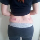 Day 1, see the bruising from the intense suction?