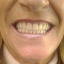 after photo of 4+4 upper and lower tempory denture implant