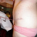 3 days post op