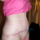 5 weeks post op back at work