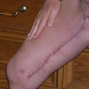 rt thigh 3 wk postop