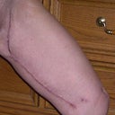 lt thigh, split in bend is mending, 3 wk postop