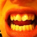 Front View. Before Invisalign.