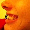 Side View. Before Invisalign.