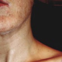 Two years after still have white lines and started getting open sores