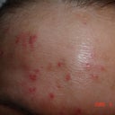 Today 20 months after MTZ DNA DAMAGE