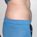 One week after second treatment (small applicator to upper and lower abs)