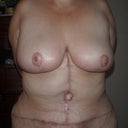 April 2011...still not completely satisfied with size of breasts.