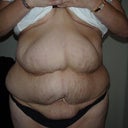 Tummy One Week Before