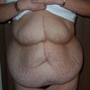 Tummy Before Pannus removal 2006