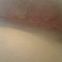 4 weeks PO - underside of breast