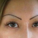 Post botox.  After long term use of botox, wrinkles lessened, forehead appears very smooth