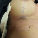 Look at how small that scar is. AWESOME