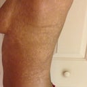 BEFORE Treatment: This is the side of my torso in different lighting.  You can clearly see the contrast here too.  My natural skin color is the brown pigment.  You can clearly see the clustered white patches.