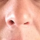 Day 10:  Uneven nostrils.  I hope this is swelling!