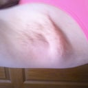 Day 20:  Right side armpit incision.  You can tell where the stitch isn't letting go and is making a little pucker holding the area up which makes it look puffier in general.  Ahhhh! lol  My ps keeps saying it'll look and heal like the other side after it releases.