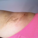 Day 20:  Left Armpit incision.  Looking good and healing great!