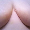 Day 20:  The spot I'm questioning at the end point at the top of the bottom incision line (top of the left breast's line).  Puffy scar tissue that will go away?  It's bothering me.  :-/