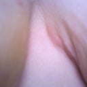 Day 20:  Close up of the problem area!  Thoughts on what it is/what I can do to help get rid of the ugly puffy area??  I want it to look great like the other side!  Will it change and look smooth with time and as my breasts change shape/soften to a more natural shape?