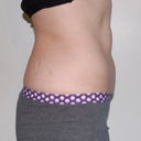 One month and two weeks after second treatment of abdomen (upper and lower)