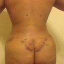 Day 5 post op