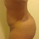 Day 5 post op