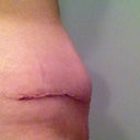 Seroma in lower abdomen