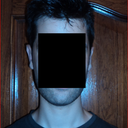 Three and a half months after otoplasty.