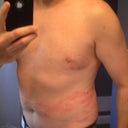 Week 9 - a few hours after Lipodissolve touchups.