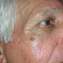 70 Year Old Male With Skin Cancer On Cheek