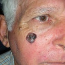 70 Year Old Male With Skin Cancer On Cheek