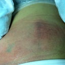 Right and Left upper abdomen just after procedure