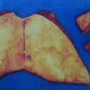 3lbs of skin removed!