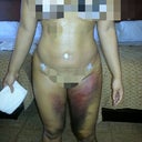 7 days post- a lot of bruising