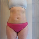6 days post op
