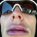 Two hours after surgery at the hospital in the truck ... I slept for an 1 45 min after surgery and finally woke up the purple on my lips (the top is no bruising just marker i guess they tried to gently wipe off )and face is the marker he used to mark me with