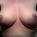 4 Weeks post op